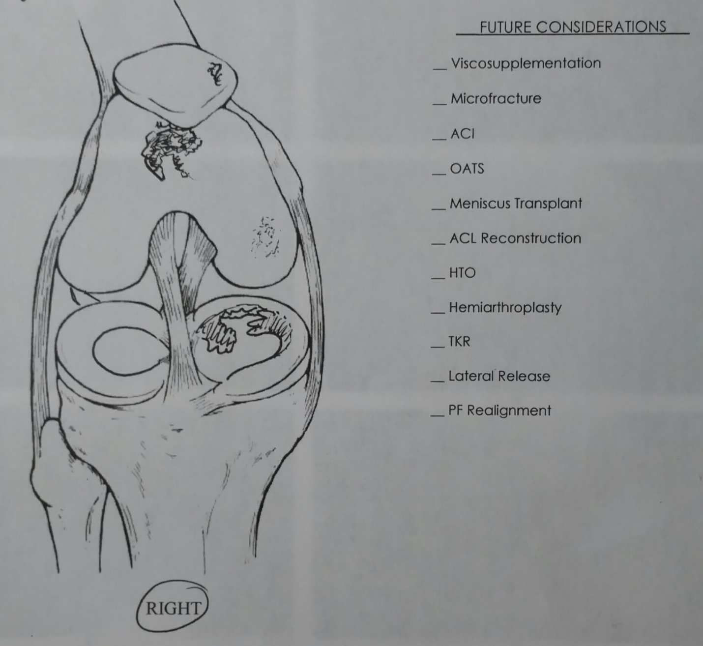 Doctor's sketch of right knee meniscus